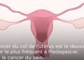 SANTE – Quand, comment et pourquoi se faire dépister du cancer du col de l’utérus ?