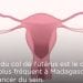 SANTE – Quand, comment et pourquoi se faire dépister du cancer du col de l’utérus ?