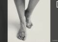 SANTE – Comprendre la difficulté et la complexité du vitiligo pour une meilleure prise en charge